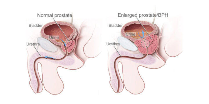 Angsamerah Articles Benign Prostatic Hypertrophy