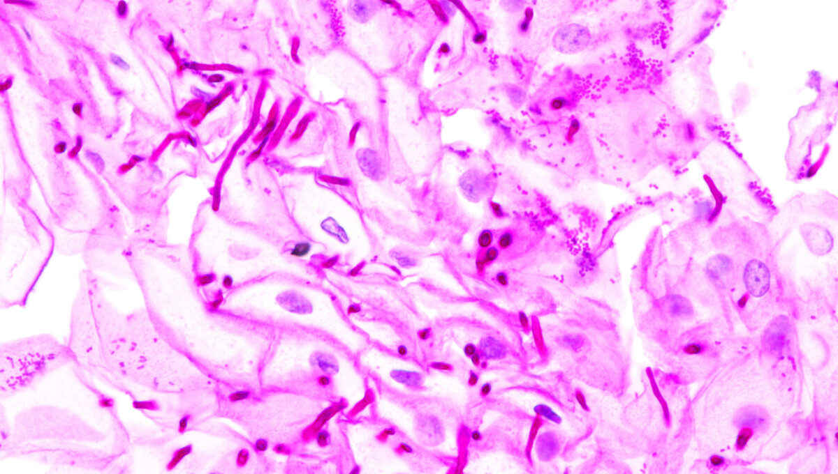 Хронический кожно-слизистый кандидоз патогенез. Кандиды половых органов. Диагностика кандидоза. Candida albicans под микроскопом. Грибок кандида под микроскопом.