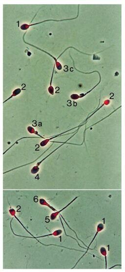 spermatozoa dalam analisa sperma